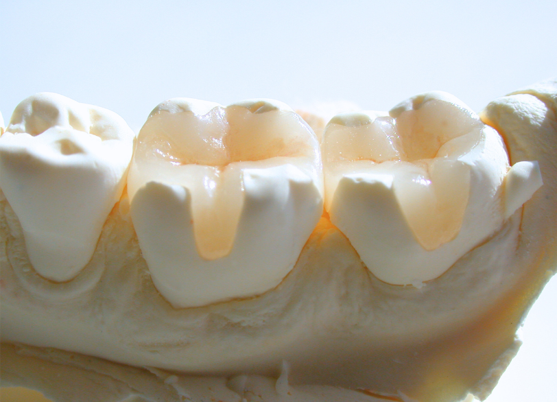 精密な修復物｜芦屋ラポルテ