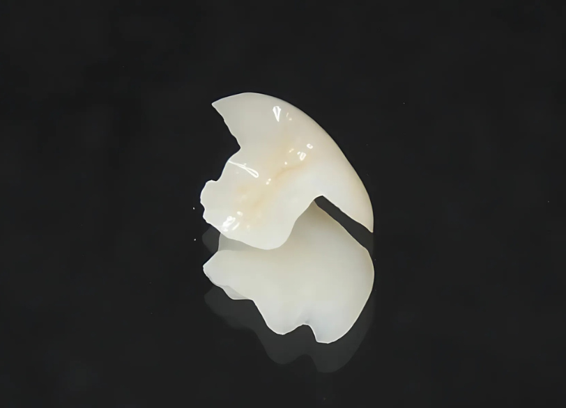 e.max（イーマックス）インレー｜芦屋ラポルテ