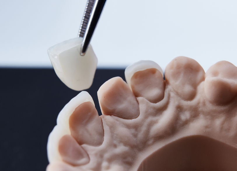 ラミネートベニア｜芦屋ラポルテ