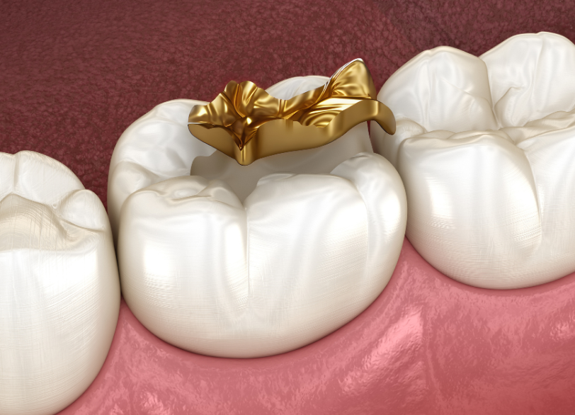 ゴールドインレー｜芦屋ラポルテ