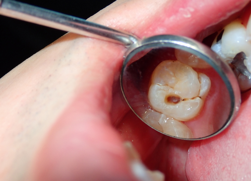 虫歯はなぜできるのか｜芦屋ラポルテ