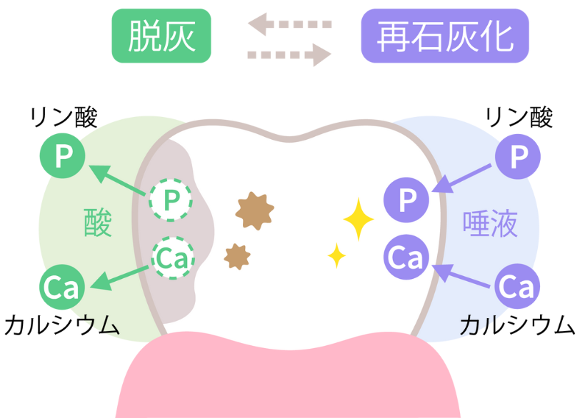 菌が作り出す「酸」によって歯が溶ける｜芦屋ラポルテ