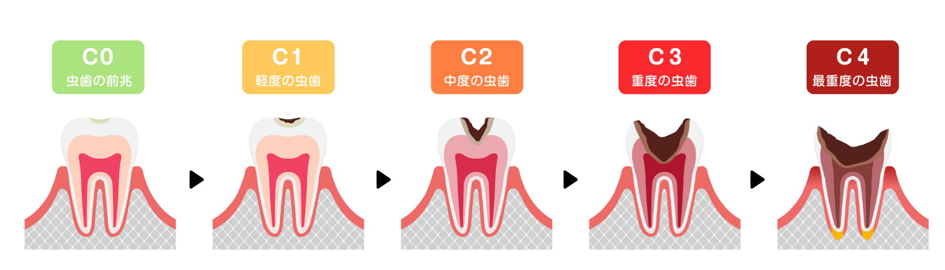 虫歯の進行｜芦屋ラポルテ