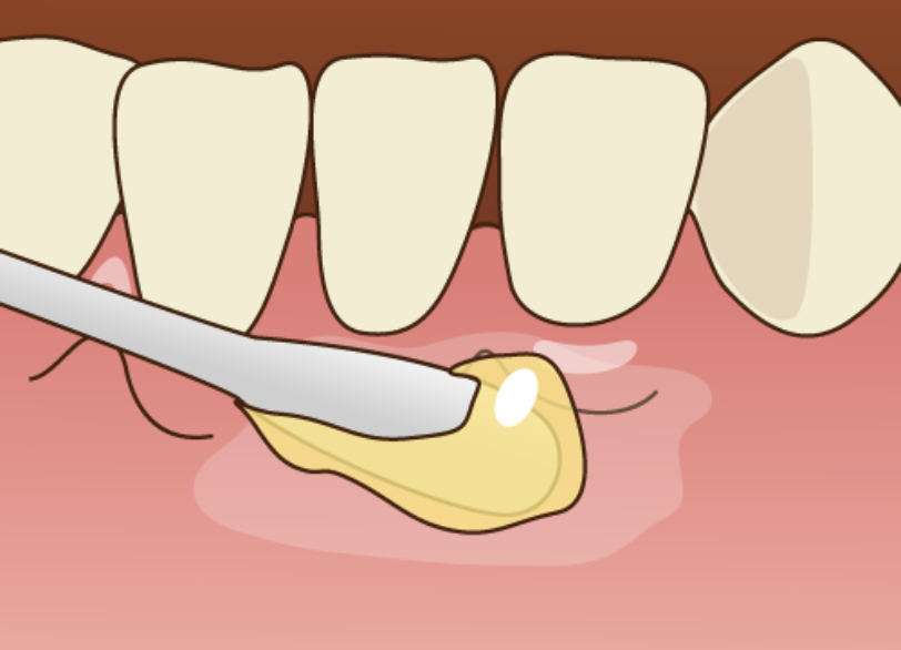 表面麻酔｜芦屋ラポルテ