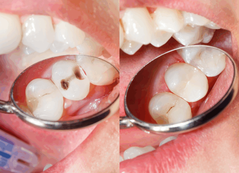 コンポジットレジン｜芦屋ラポルテ