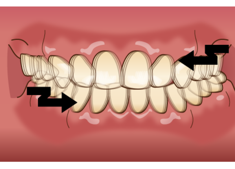 歯ぎしり｜芦屋ラポルテ