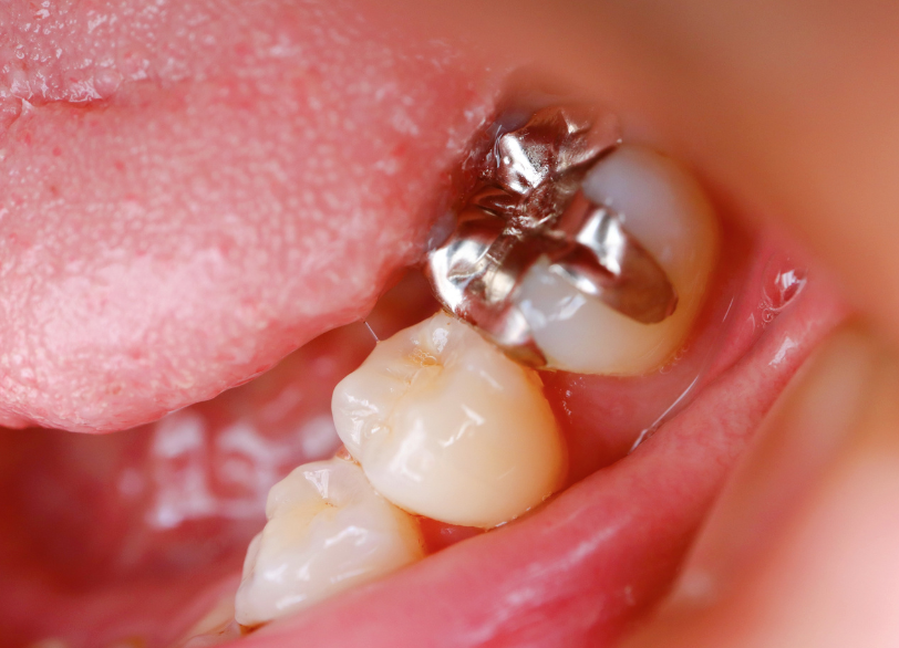 詰め物｜芦屋ラポルテ