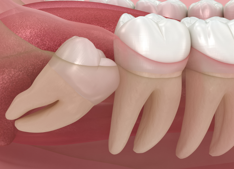 歯並び全体を乱してしまう原因となる可能性｜芦屋ラポルテ