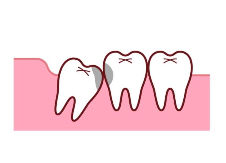 隣の歯を虫歯にしてしまうリスク｜芦屋ラポルテ