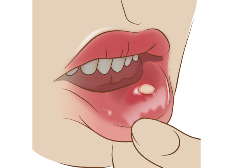 口内炎｜芦屋ラポルテ