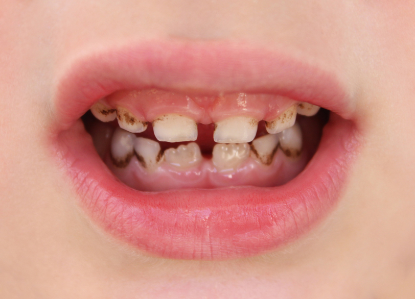 虫歯になってしまった場合｜芦屋ラポルテ