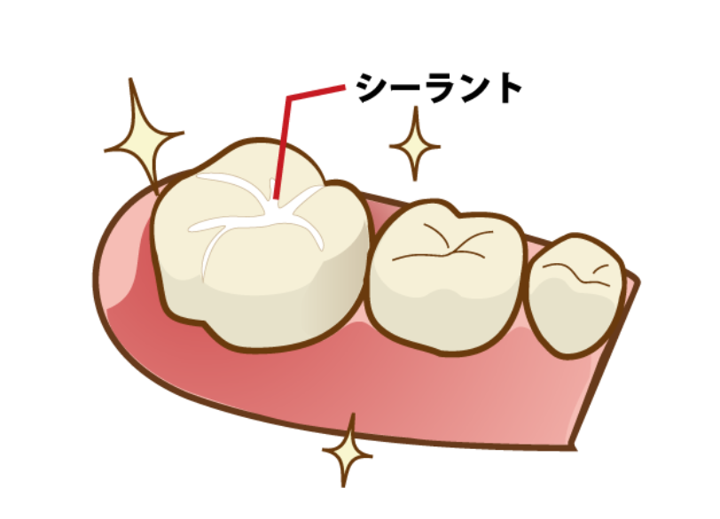 シーラント｜芦屋ラポルテ