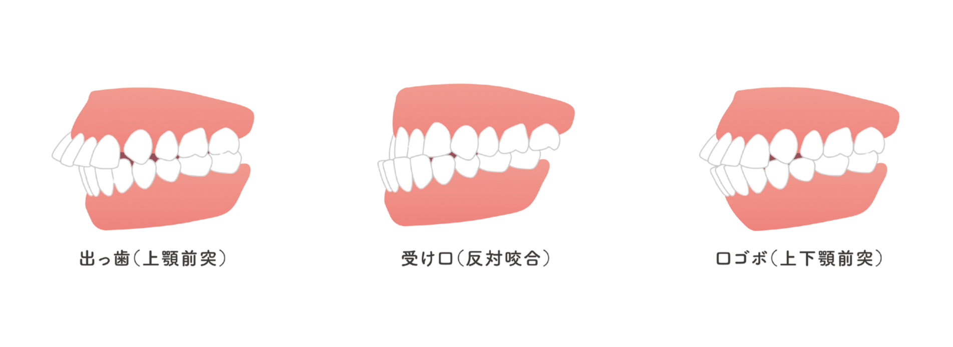 歯並び・癖が気になる場合はご相談ください｜芦屋ラポルテ