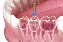 根管治療｜芦屋ラポルテ