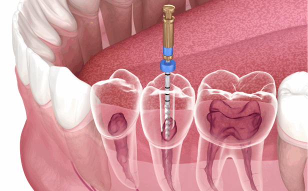 根管治療｜芦屋ラポルテ