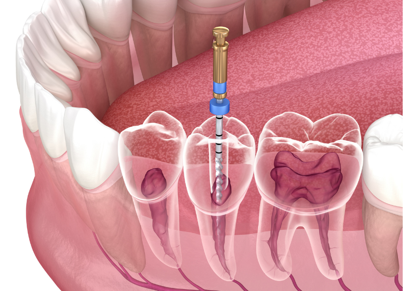 根管治療｜芦屋ラポルテ