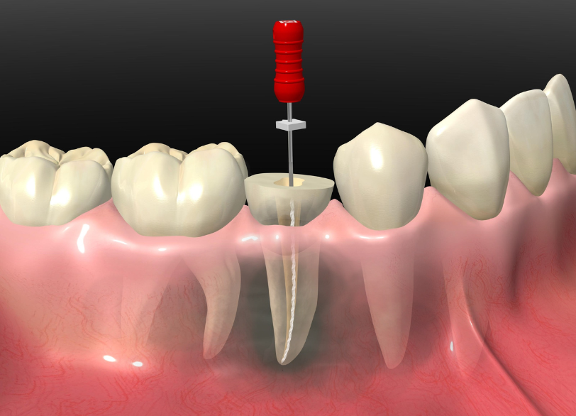 根管治療の治療内容｜芦屋ラポルテ