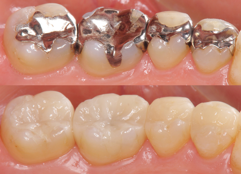 虫歯や不適合な修復物が原因の場合｜芦屋ラポルテ