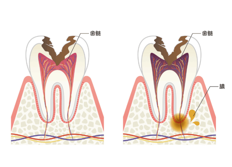 進行した虫歯｜芦屋ラポルテ