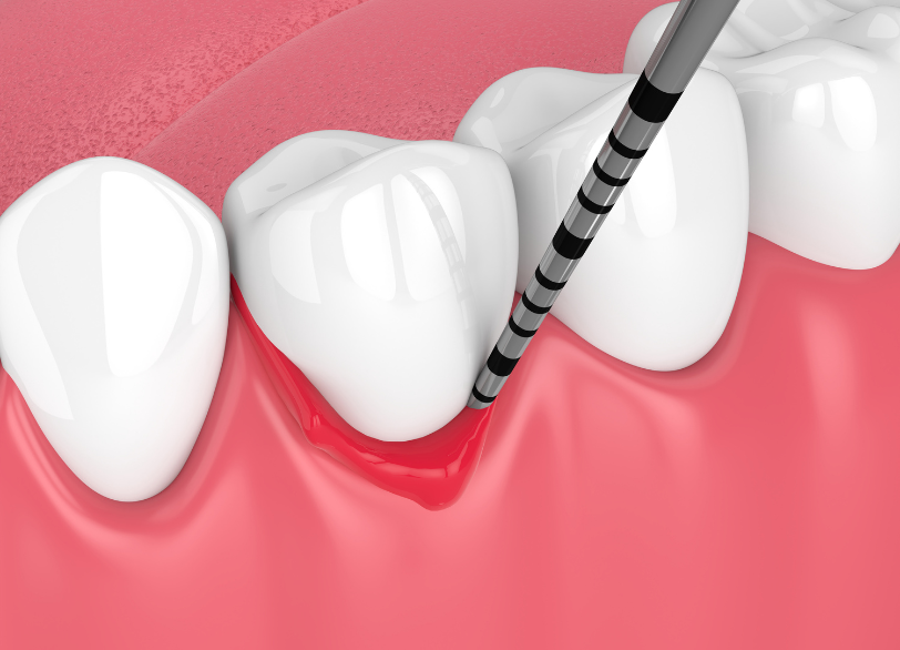 歯周病｜芦屋ラポルテ