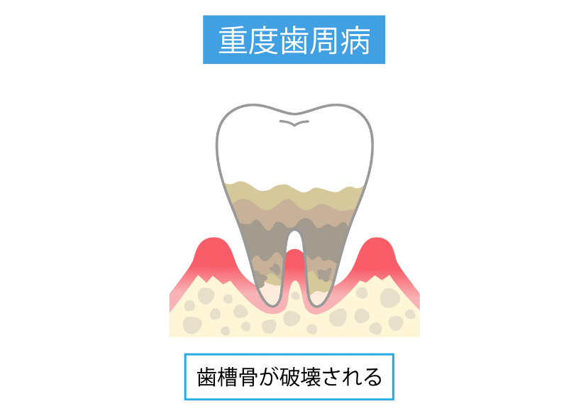 歯槽骨（歯を支える骨）の破壊｜芦屋ラポルテ
