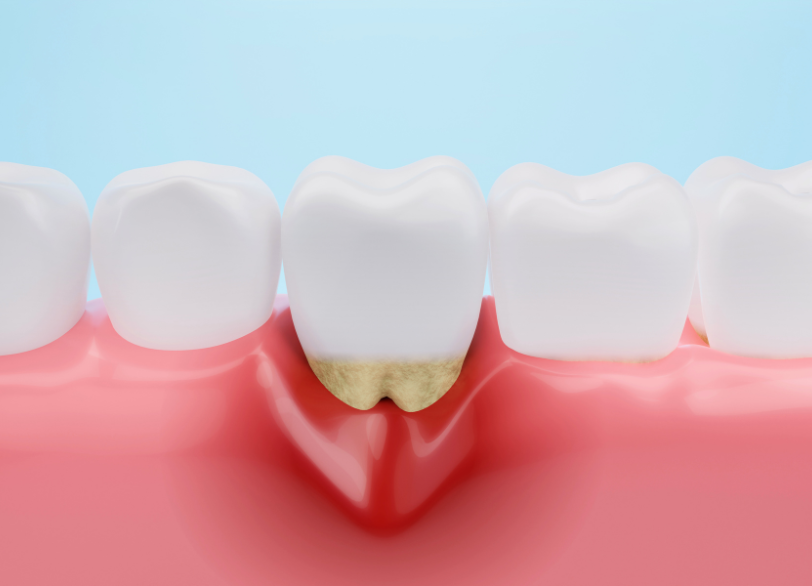 サイレント・ディジーズ｜芦屋ラポルテ