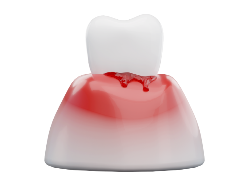 歯ぐきの炎症｜芦屋ラポルテ