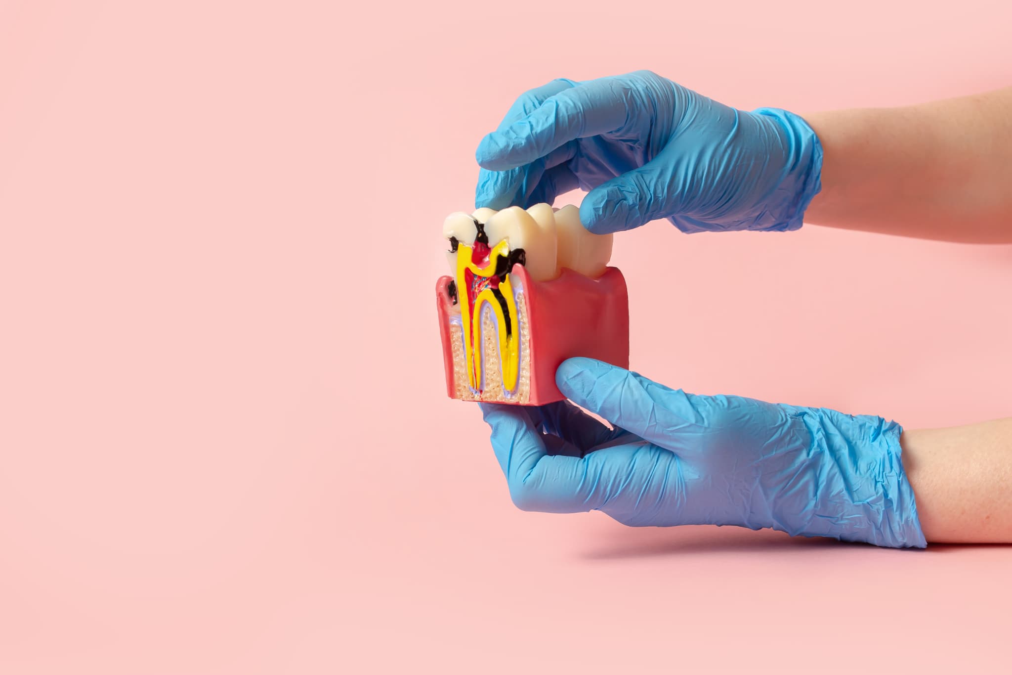 虫歯の説明をする歯科医師