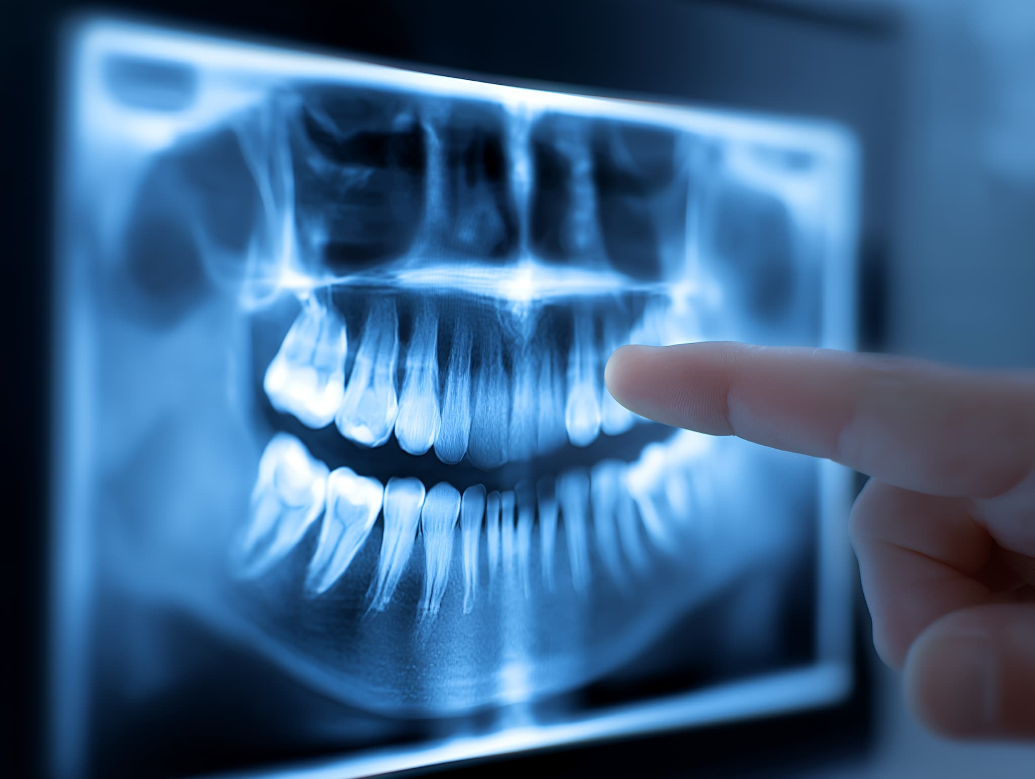 レントゲンで根管の様子を確認する様子