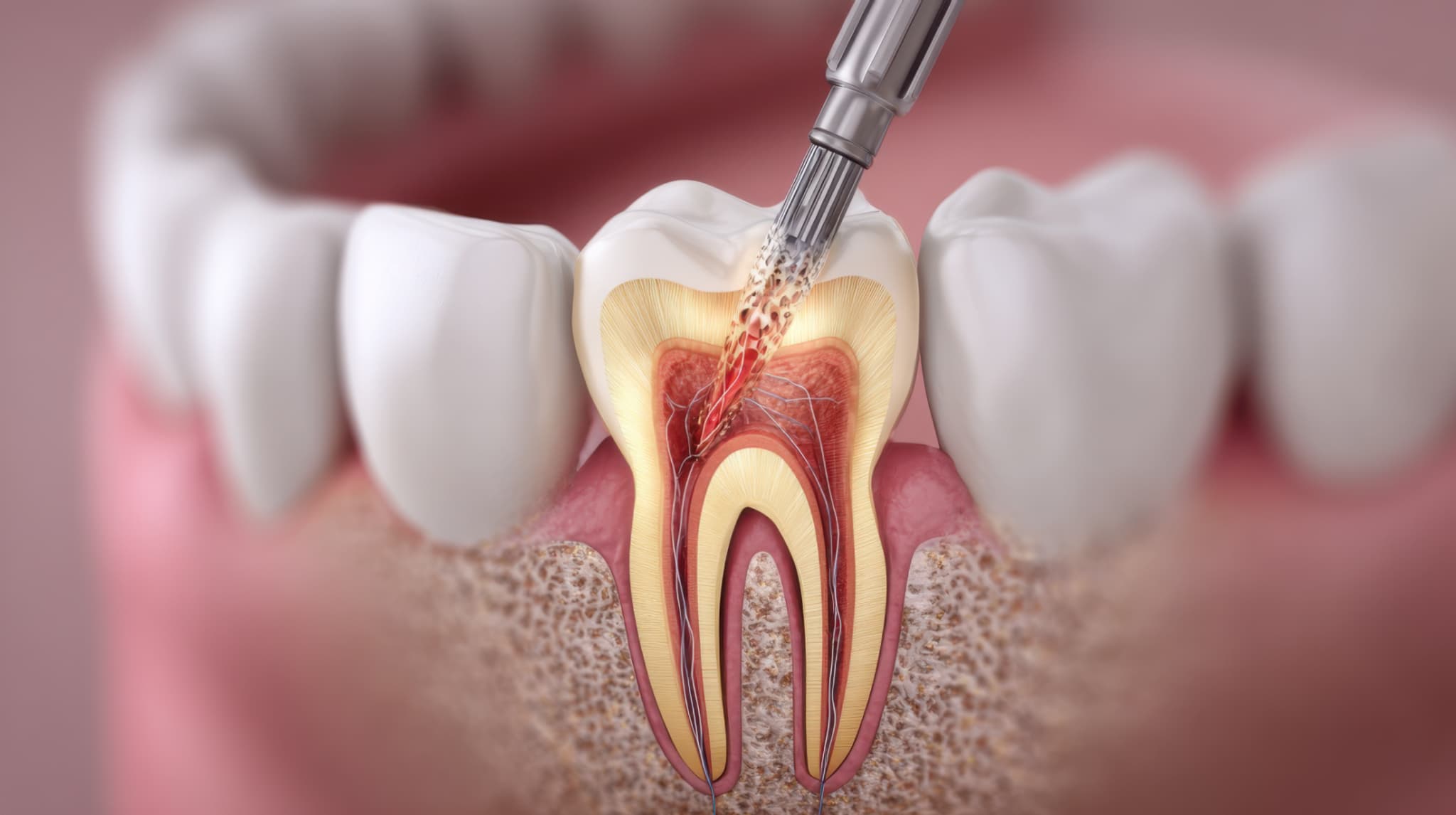 根管治療のイメージ