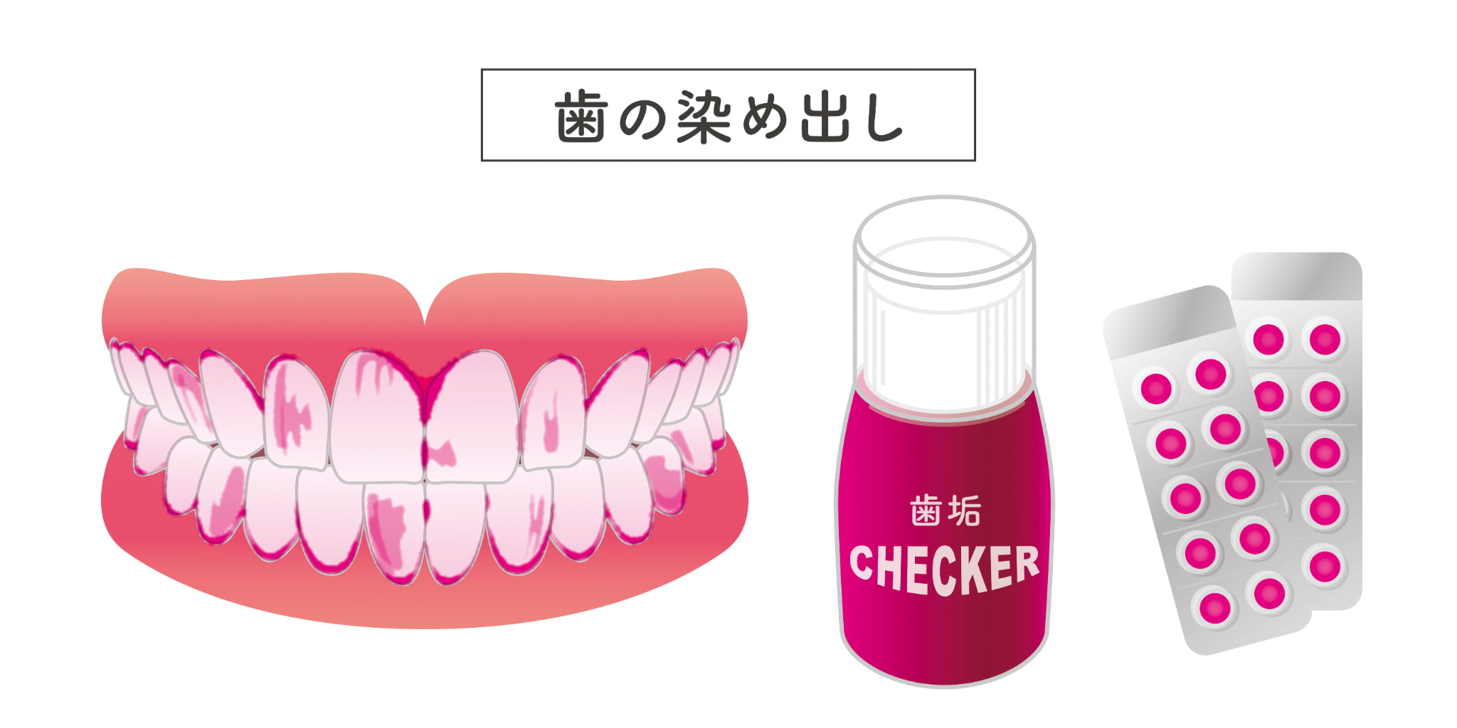 ブラッシング指導で行う歯の磨き残しを染め出すイメージ