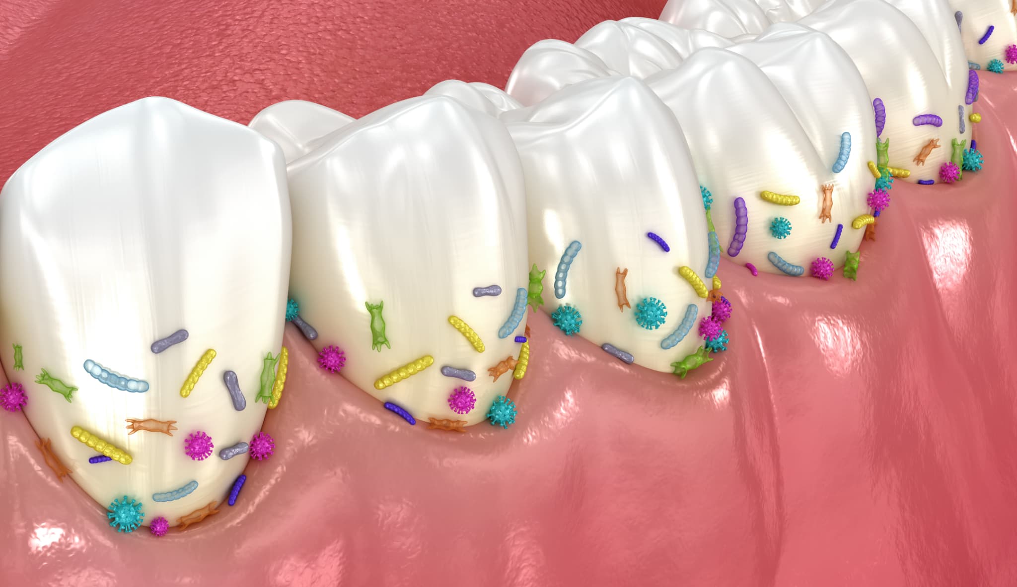 プラークに繁殖した細菌で歯周病になるイメージ